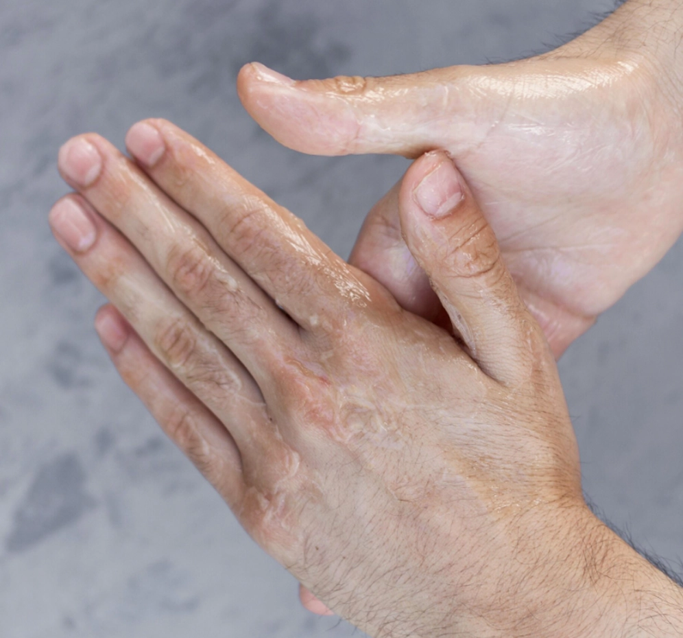 Avuç İçinde Siğil