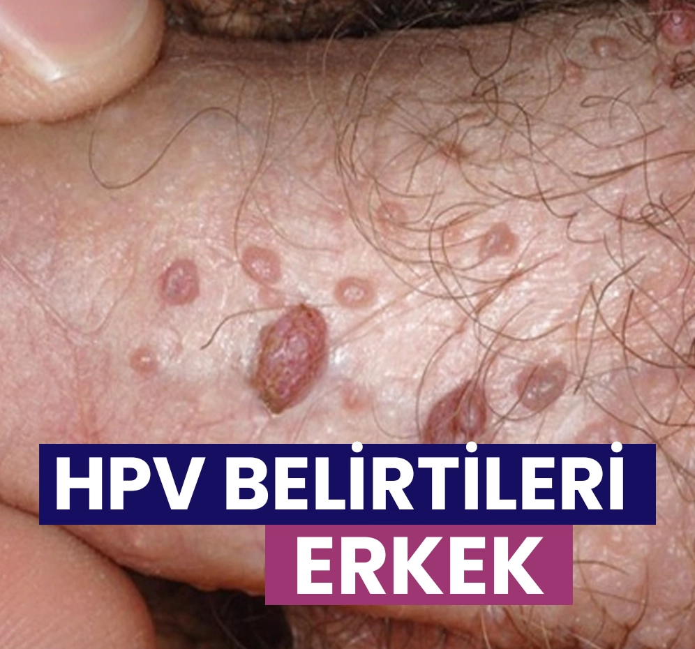 HPV Belirtileri Erkek
