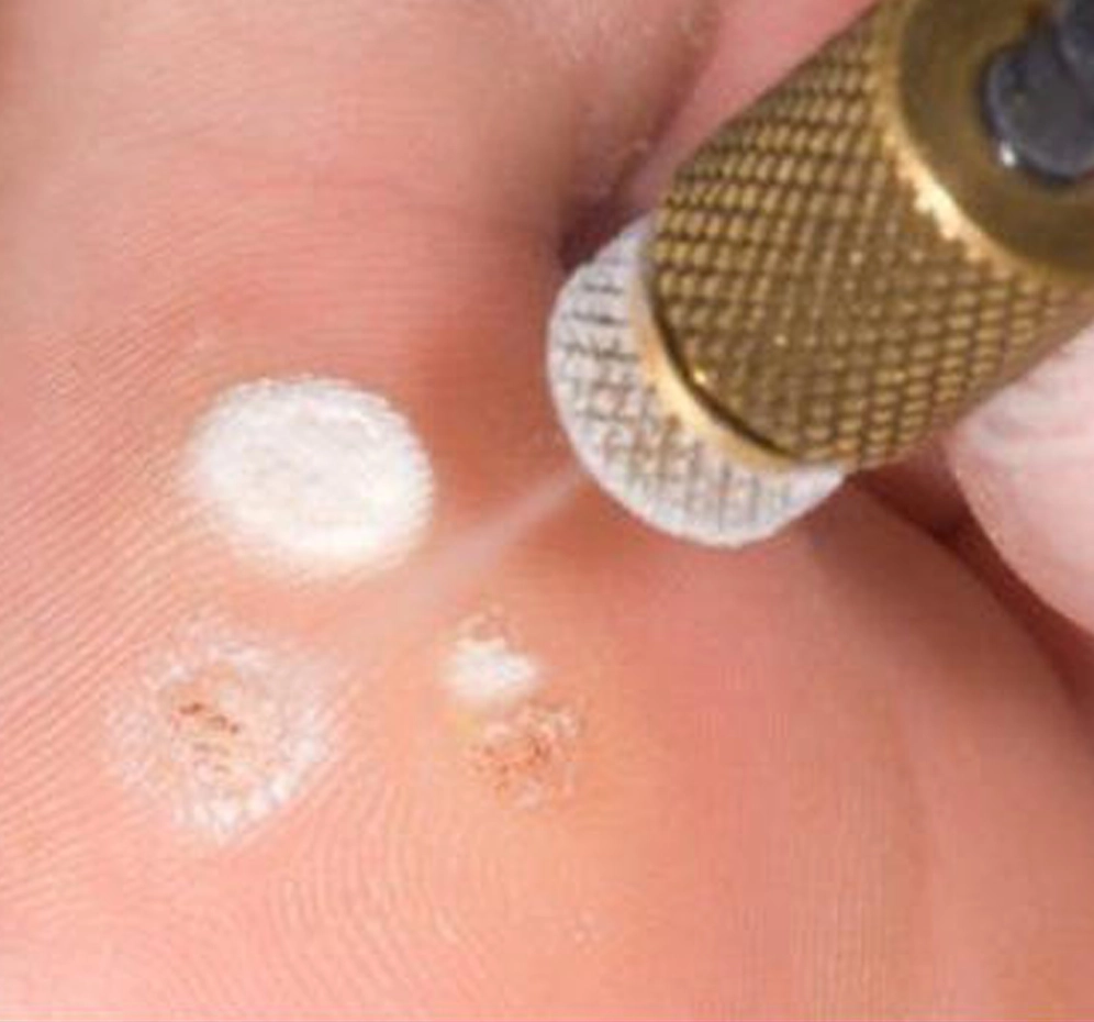 Kriyoterapi ile Siğil Tedavisi